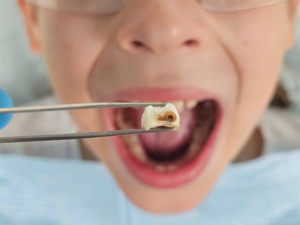 Best Emergency Treatment for Dental Infections or Abscesses in St Clair, MO
